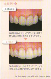 【Before】以前の治療したブリッジが合わず、歯茎や隣の歯との間に隙間ができています。 【After】強度の高いオールセラミックブリッジなら自然な歯列を得ることができます。